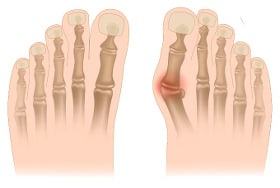 Normaler Fuß versus Hallux Valgus - Der Mittelfußknochen führt zu Schmerzen beim Wandern