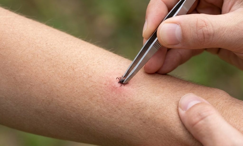 zecke-entfernen-pinzette-anleitung - Renner XXL Magazin Person uses tweezers to remove a tick from a forearm; a small red puncture is visible nearby.